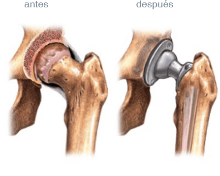 Antes y despues protesis total de rodilla
