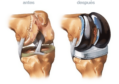 Antes y despues protesis total de rodilla